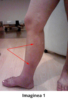 tratamentul simptomelor vitrice ale picioarelor varicoase interne)