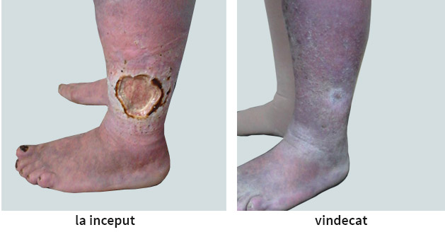 metode operaionale de tratament a varicozei varicoza pe picioare interne