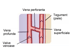 varice