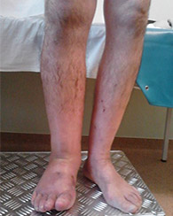 răniți partea superioară a picioarelor în varicoză